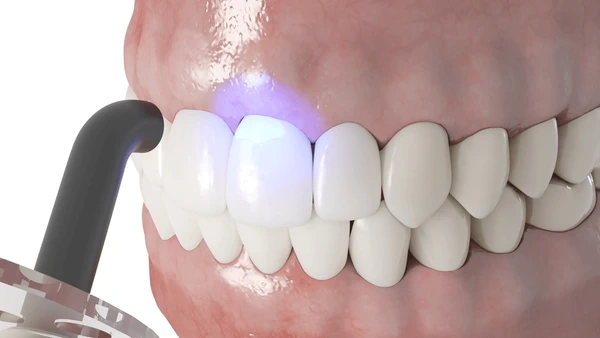 dental bonding in kamloops, bc