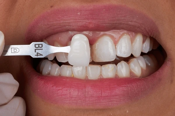 dental bonding near you