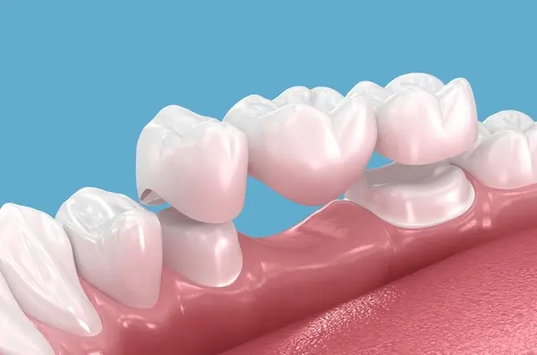 dental bridges in kamloops, bc