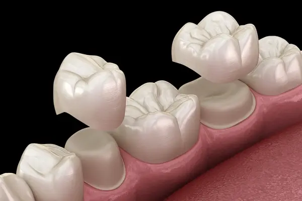 dental crowns in kamloops, bc