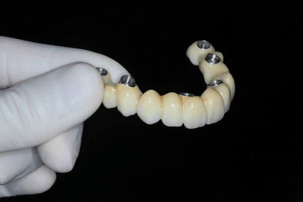 implant-supported bridges near you