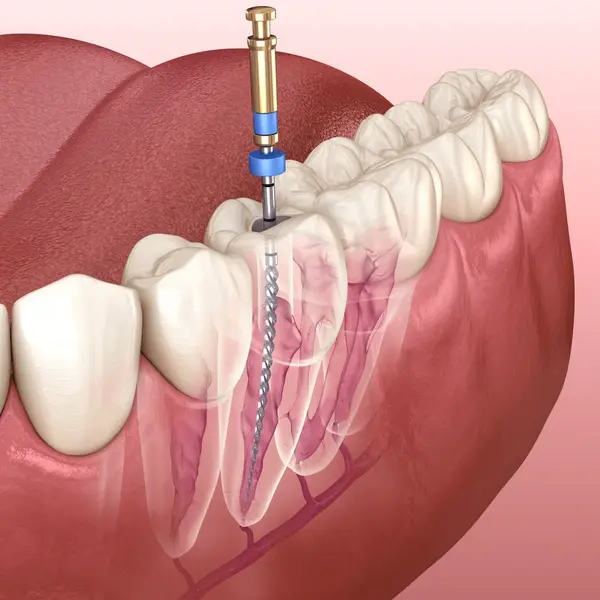 root canal treatment in kamloops, bc