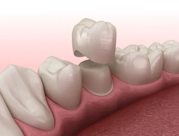 same-day crowns near you