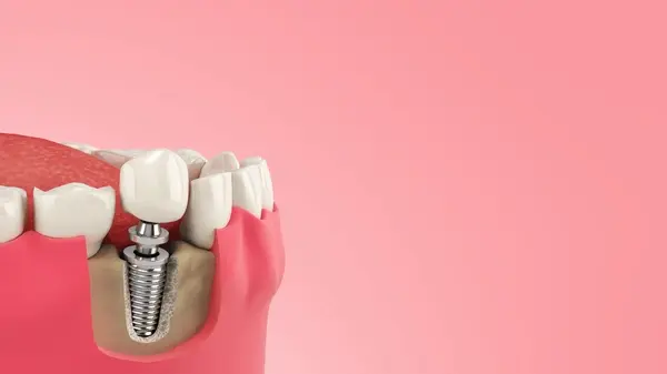 single dental implants in kamloops, bc