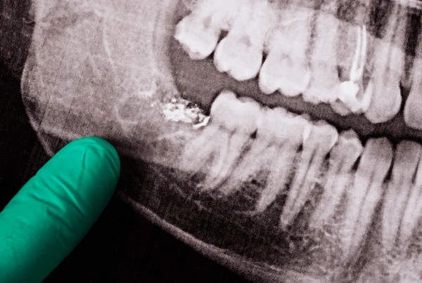 teeth extraction near you
