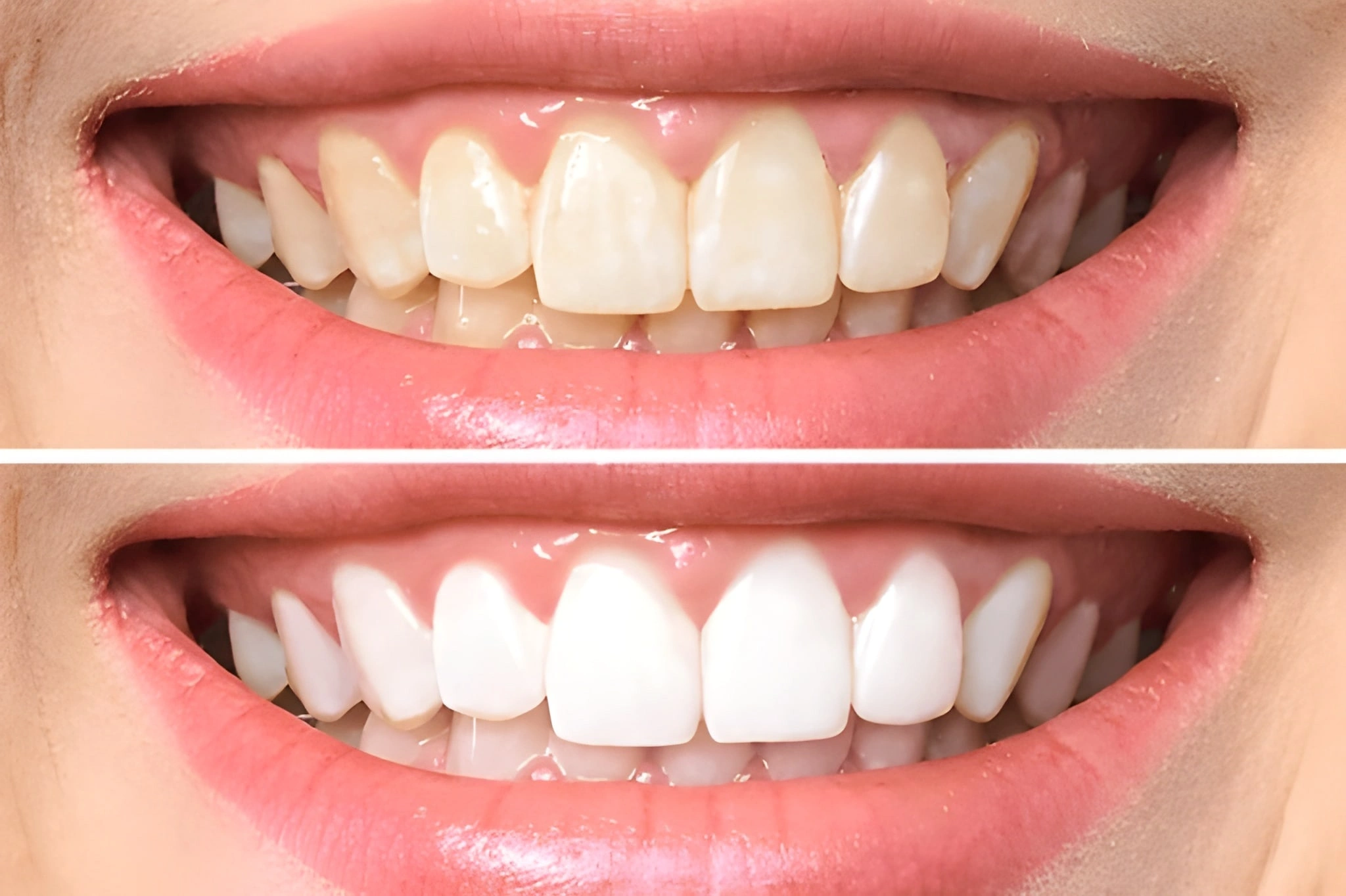 teeth whitening in kamloops, bc
